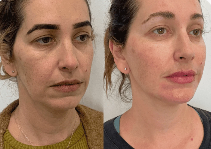 Tratamento de 4 meses Peptídeos de Cobre GHK-CU