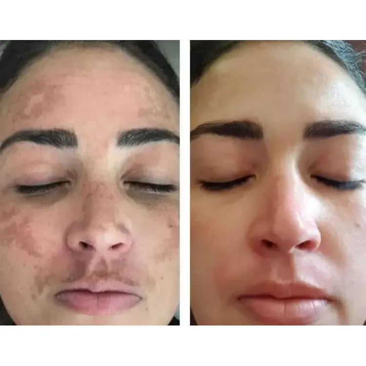 Rosa Mosqueta Amazônica 12 meses de tratamento (30ml)