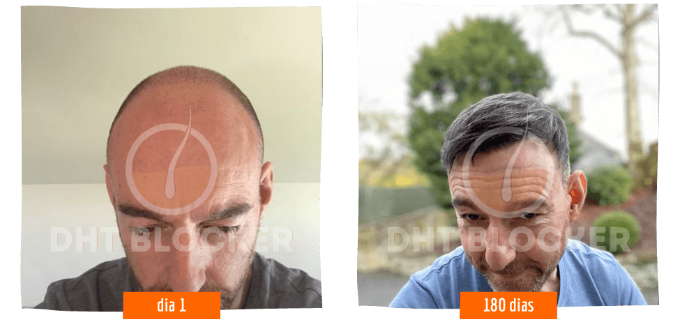 DHT BLOCKER 12 FRASCOS