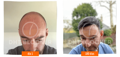 DHT BLOCKER 12 FRASCOS