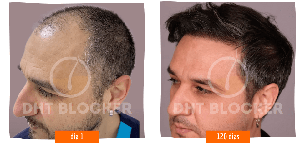 DHT BLOCKER 12 FRASCOS