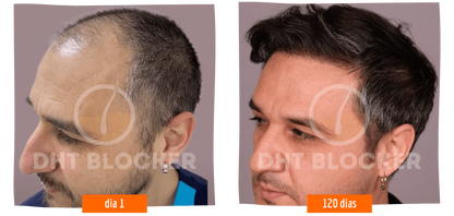 DHT BLOCKER 12 FRASCOS