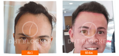 DHT BLOCKER 12 FRASCOS