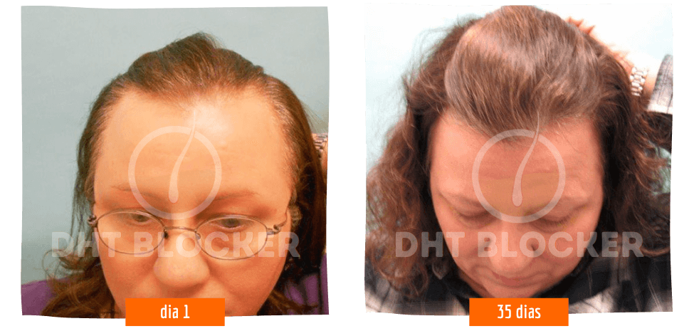 DHT BLOCKER 12 FRASCOS