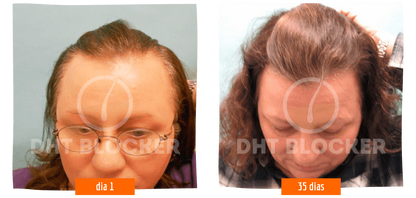 DHT BLOCKER 12 FRASCOS