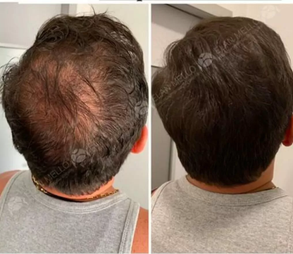 DHT BLOCKER 12 FRASCOS