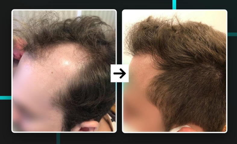 DHT BLOCKER 12 FRASCOS